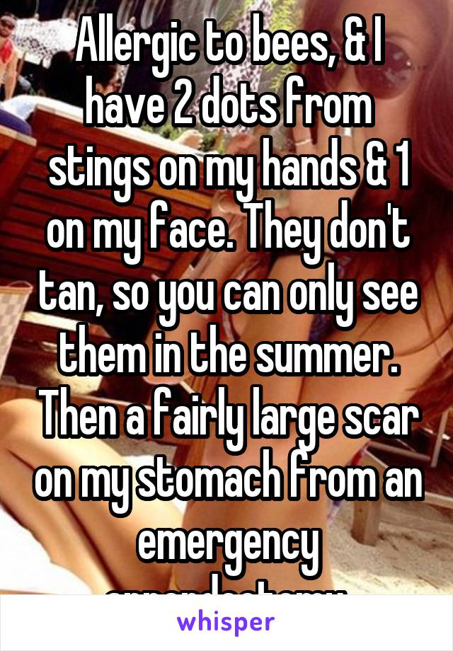 Allergic to bees, & I have 2 dots from stings on my hands & 1 on my face. They don't tan, so you can only see them in the summer. Then a fairly large scar on my stomach from an emergency appendectomy 