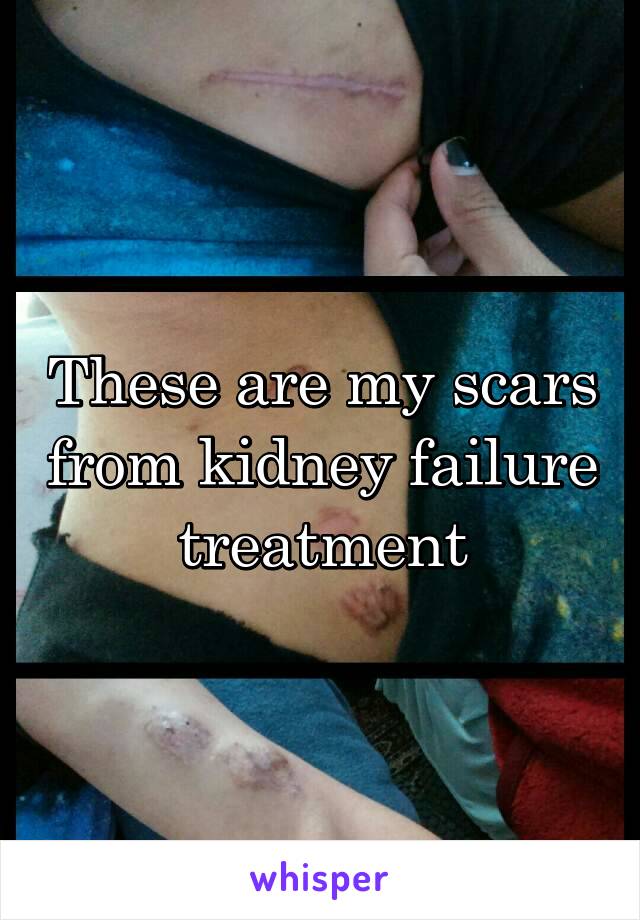 These are my scars from kidney failure treatment