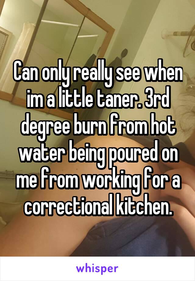 Can only really see when im a little taner. 3rd degree burn from hot water being poured on me from working for a correctional kitchen.