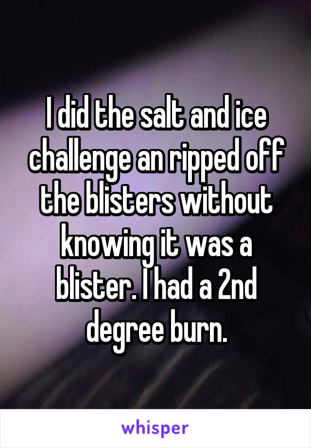 I did the salt and ice challenge an ripped off the blisters without knowing it was a blister. I had a 2nd degree burn.