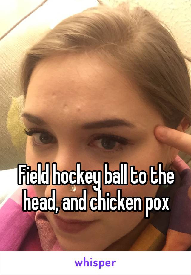 



Field hockey ball to the head, and chicken pox