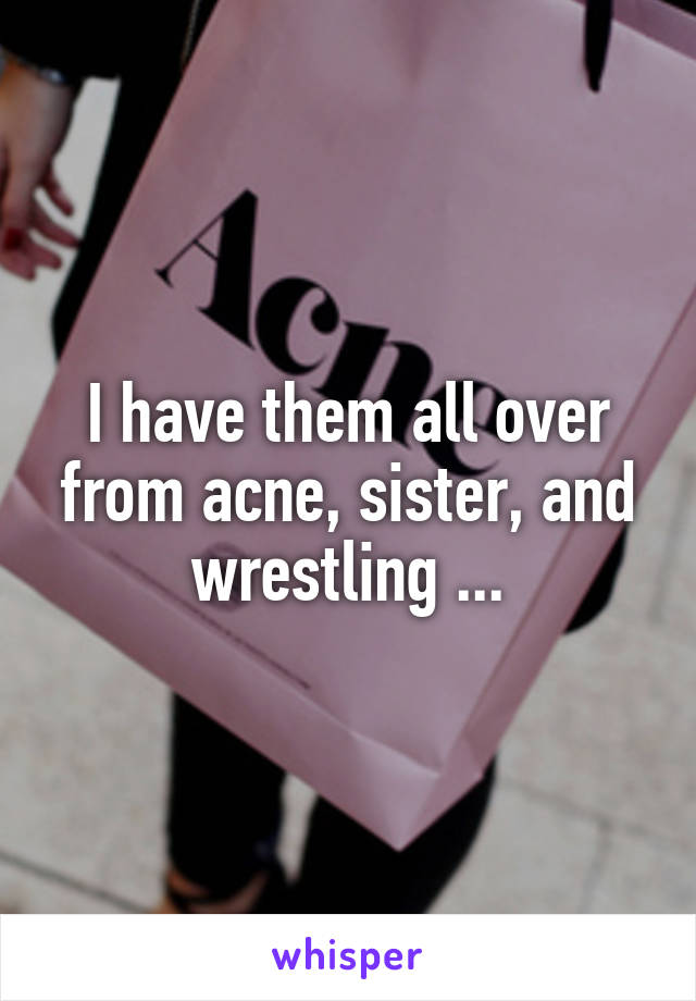 I have them all over from acne, sister, and wrestling ...