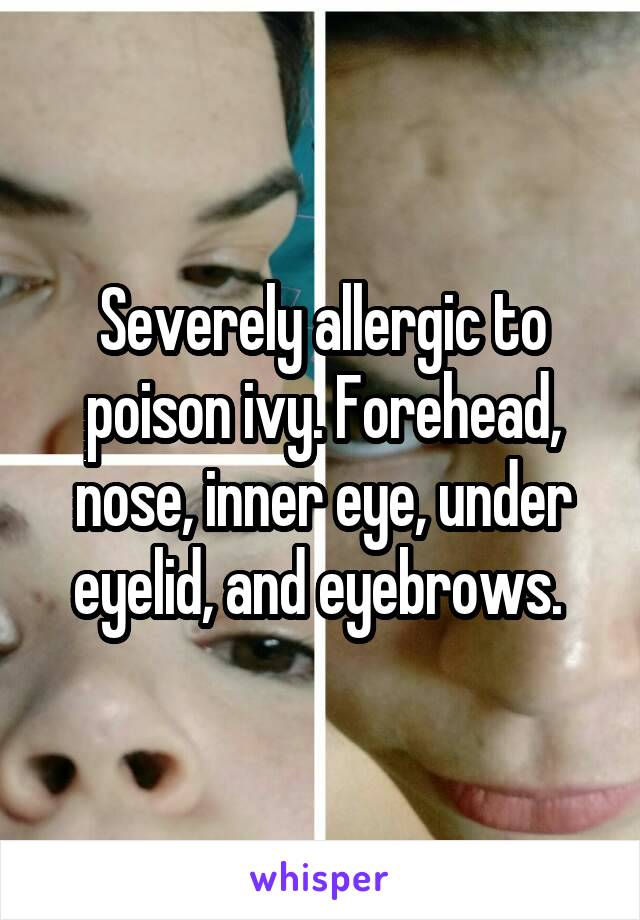 Severely allergic to poison ivy. Forehead, nose, inner eye, under eyelid, and eyebrows. 