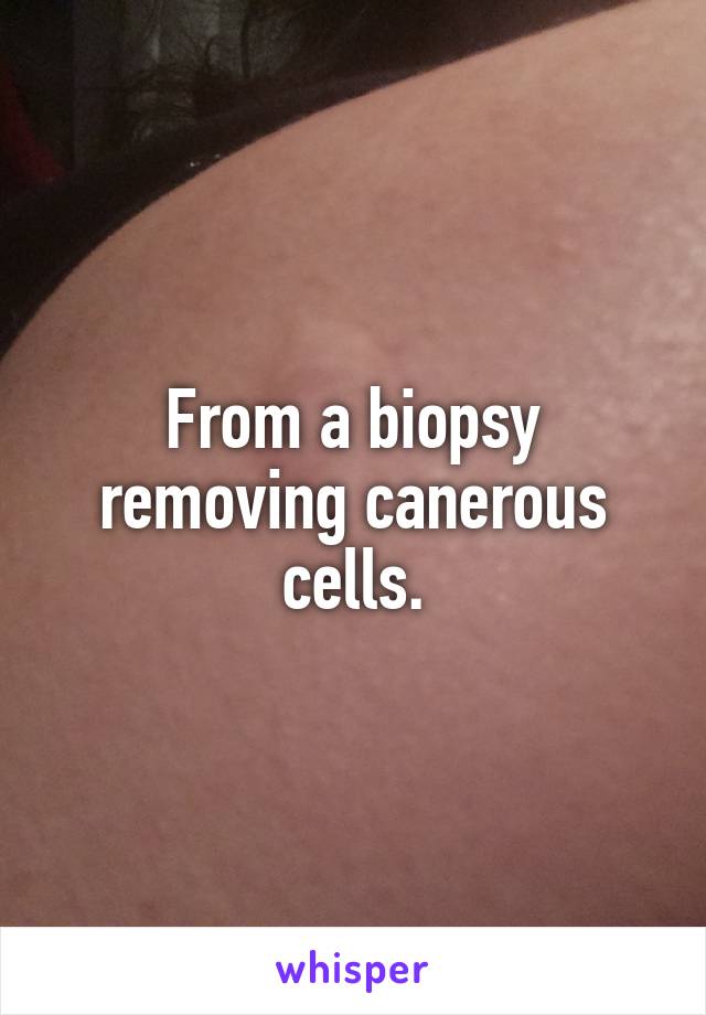 From a biopsy removing canerous cells.