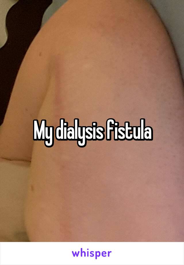 My dialysis fistula