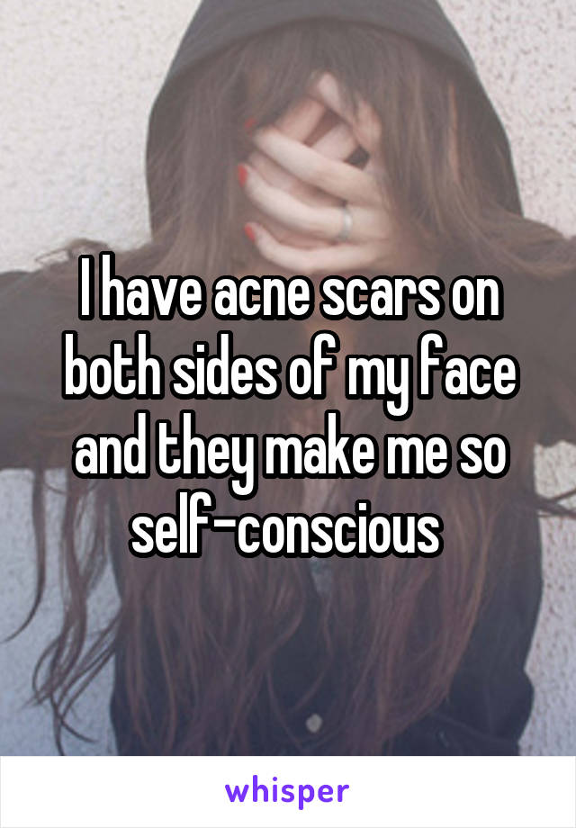 I have acne scars on both sides of my face and they make me so self-conscious 