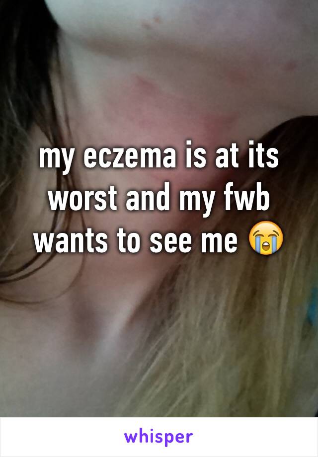 my eczema is at its worst and my fwb wants to see me 😭