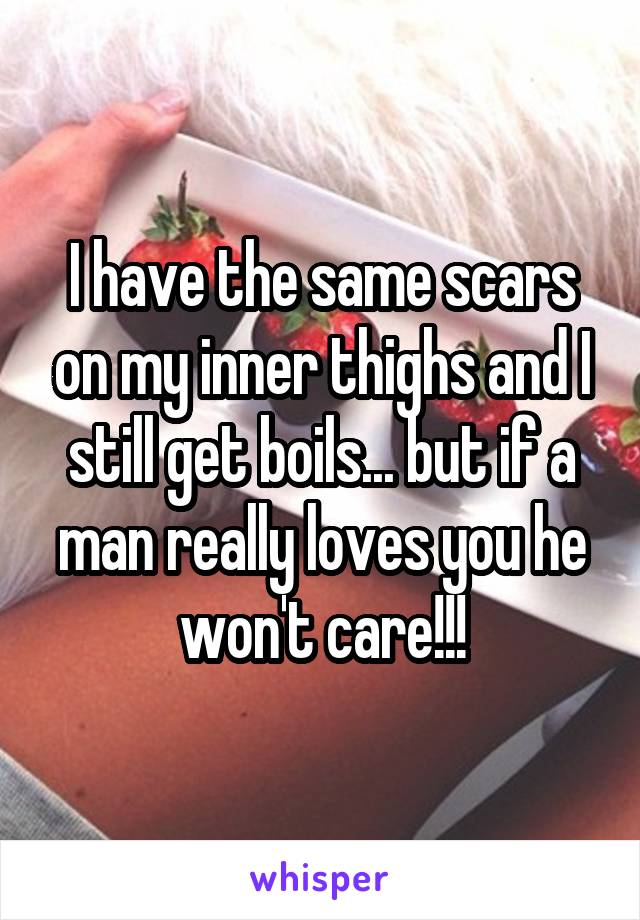 I have the same scars on my inner thighs and I still get boils... but if a man really loves you he won't care!!!