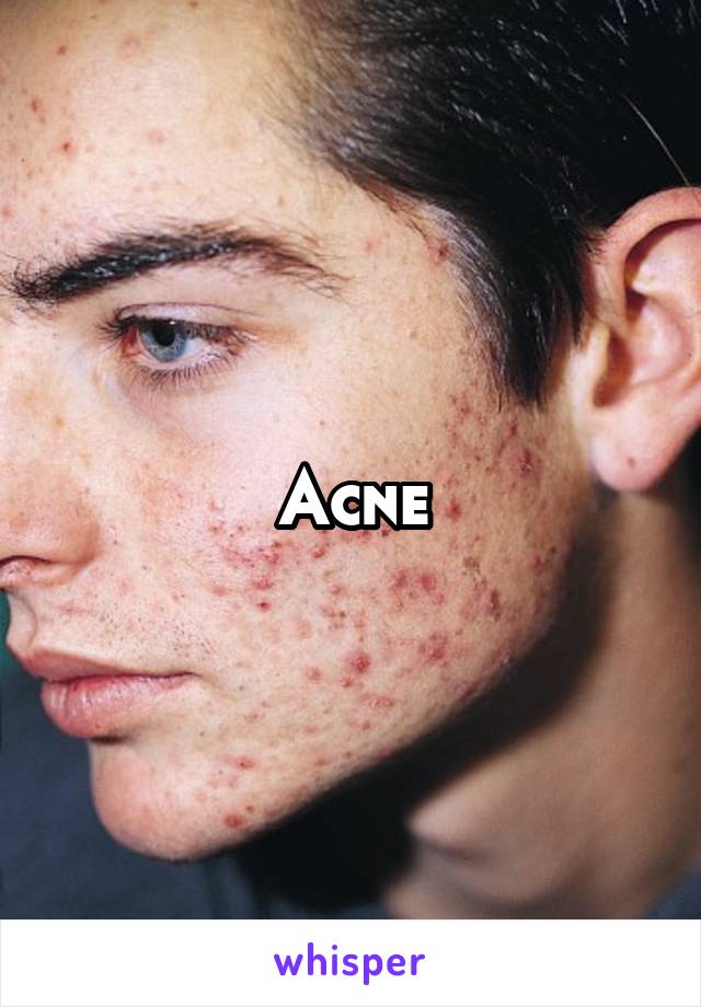 Acne