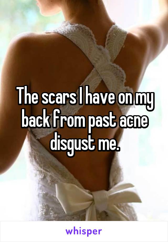 The scars I have on my back from past acne disgust me.