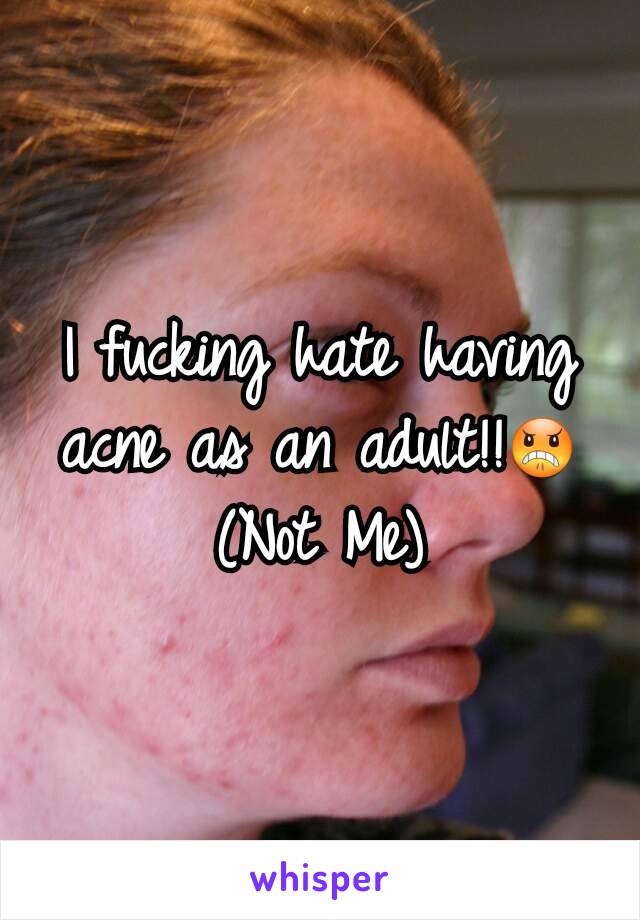 I fucking hate having acne as an adult!!😠
(Not Me)