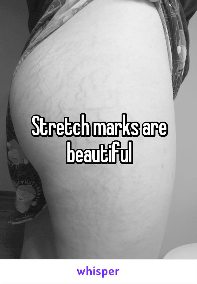 Stretch marks are beautiful