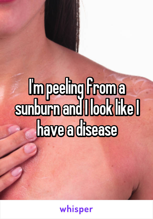 I'm peeling from a sunburn and I look like I have a disease