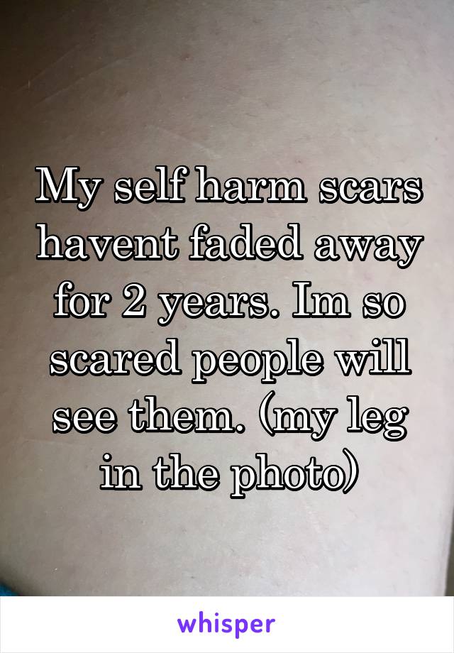 My self harm scars havent faded away for 2 years. Im so scared people will see them. (my leg in the photo)