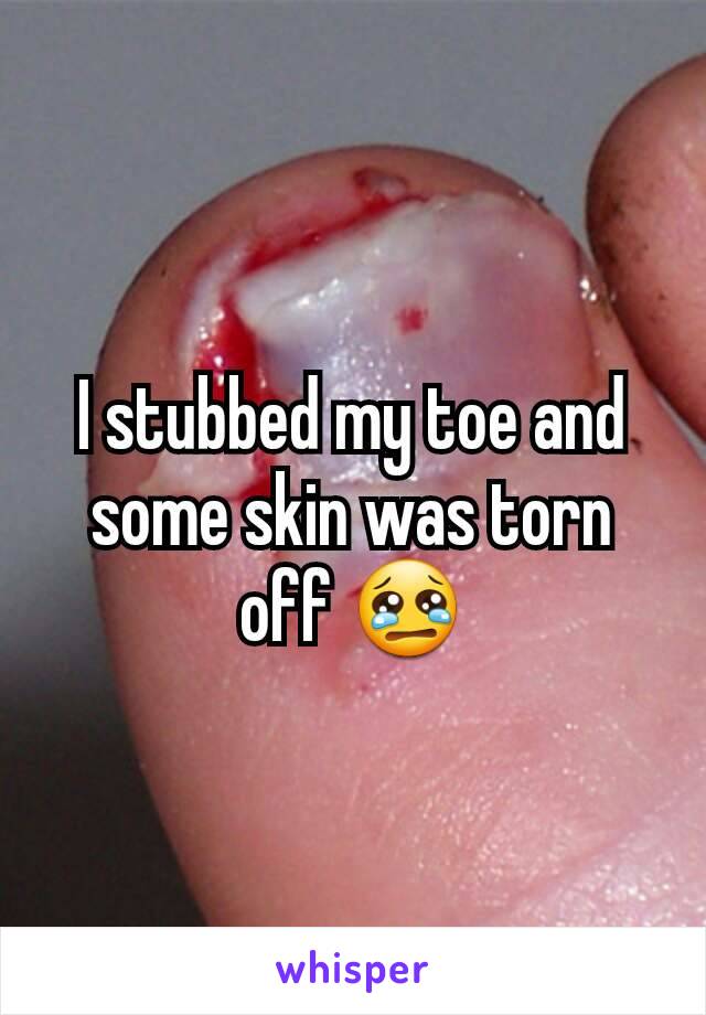I stubbed my toe and some skin was torn off 😢