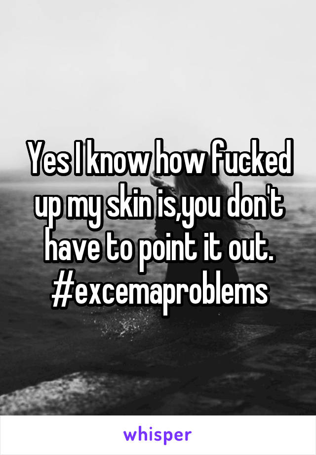 Yes I know how fucked up my skin is,you don't have to point it out. #excemaproblems