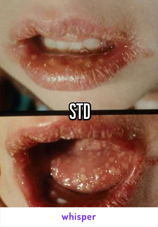 STD