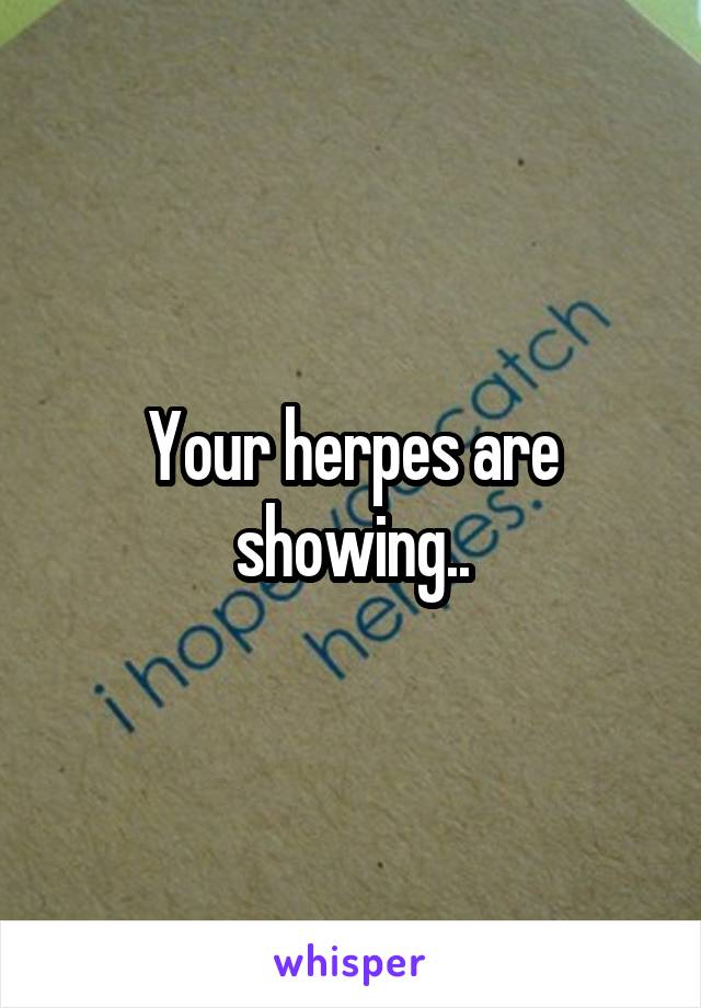 Your herpes are showing..