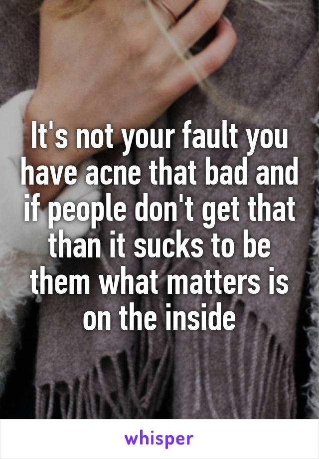 It's not your fault you have acne that bad and if people don't get that than it sucks to be them what matters is on the inside