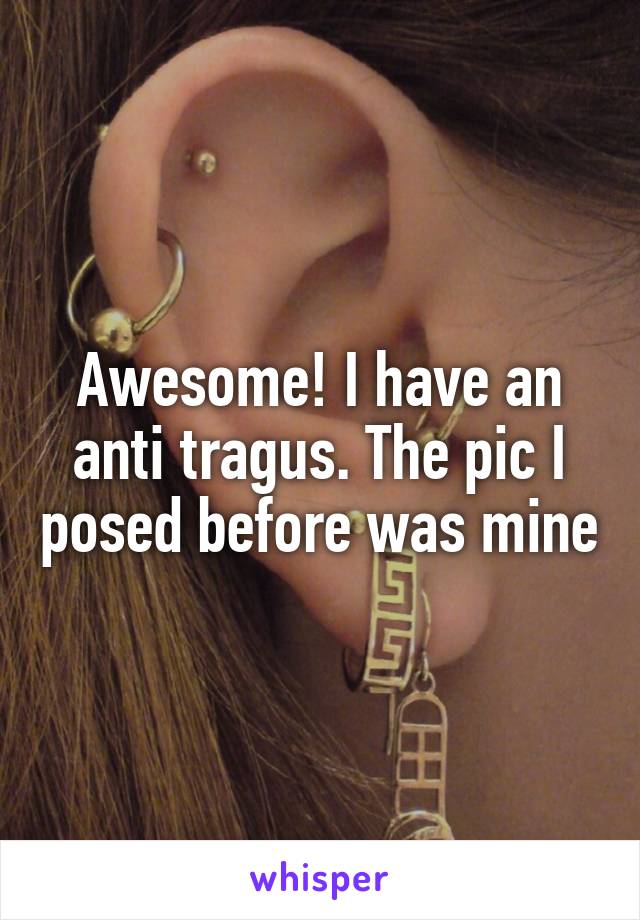 Awesome! I have an anti tragus. The pic I posed before was mine