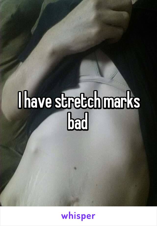 I have stretch marks bad 