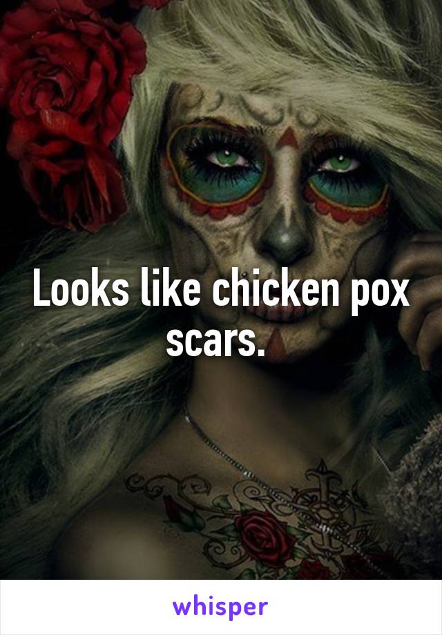 Looks like chicken pox scars. 