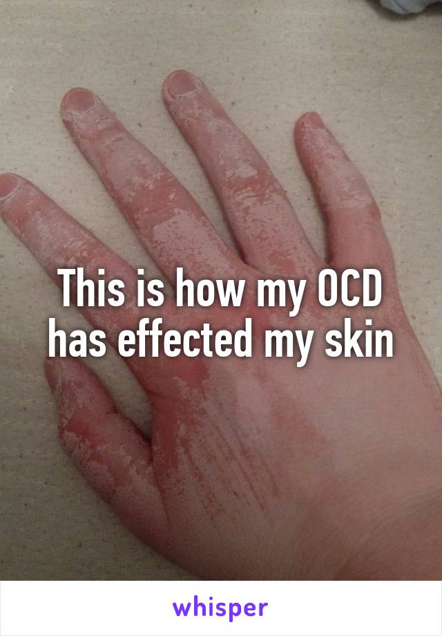 This is how my OCD has effected my skin