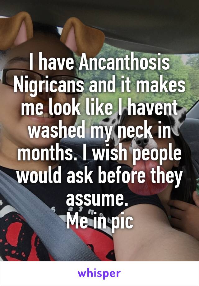 I have Ancanthosis Nigricans and it makes me look like I havent washed my neck in months. I wish people would ask before they assume. 
Me in pic