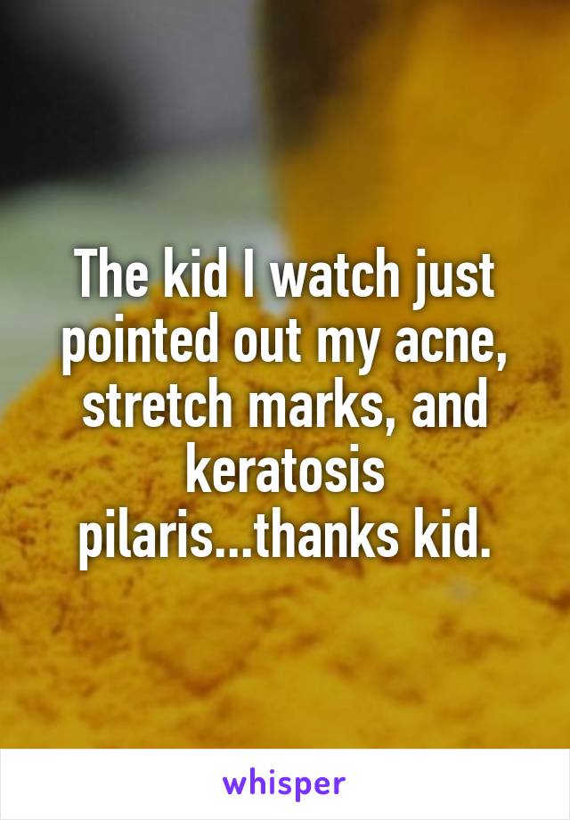 The kid I watch just pointed out my acne, stretch marks, and keratosis pilaris...thanks kid.