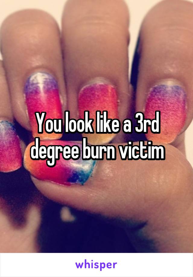 You look like a 3rd degree burn victim