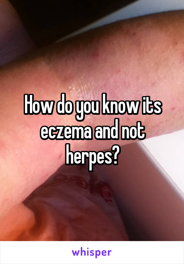 How do you know its eczema and not herpes?