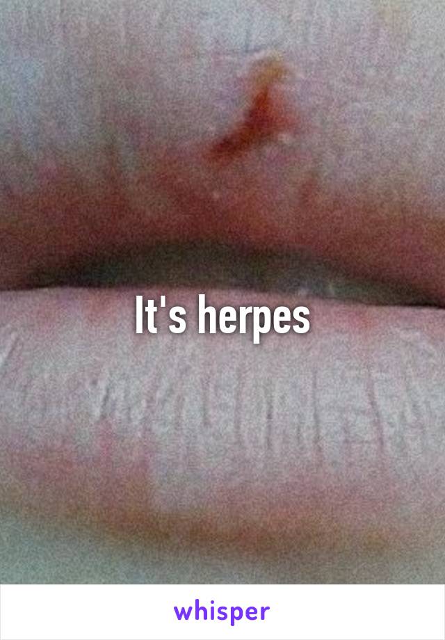 It's herpes