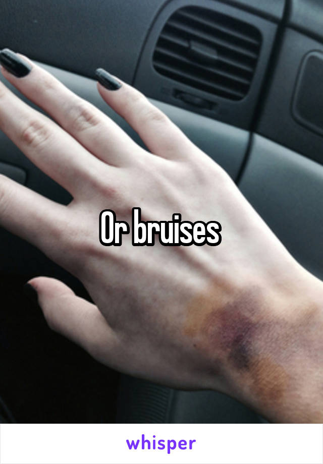 Or bruises 