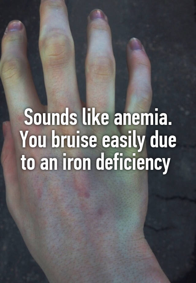 Sounds like anemia. You bruise easily due to an iron deficiency