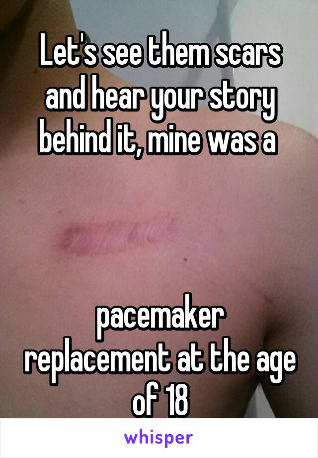 Let's see them scars and hear your story
behind it, mine was a 



pacemaker replacement at the age of 18