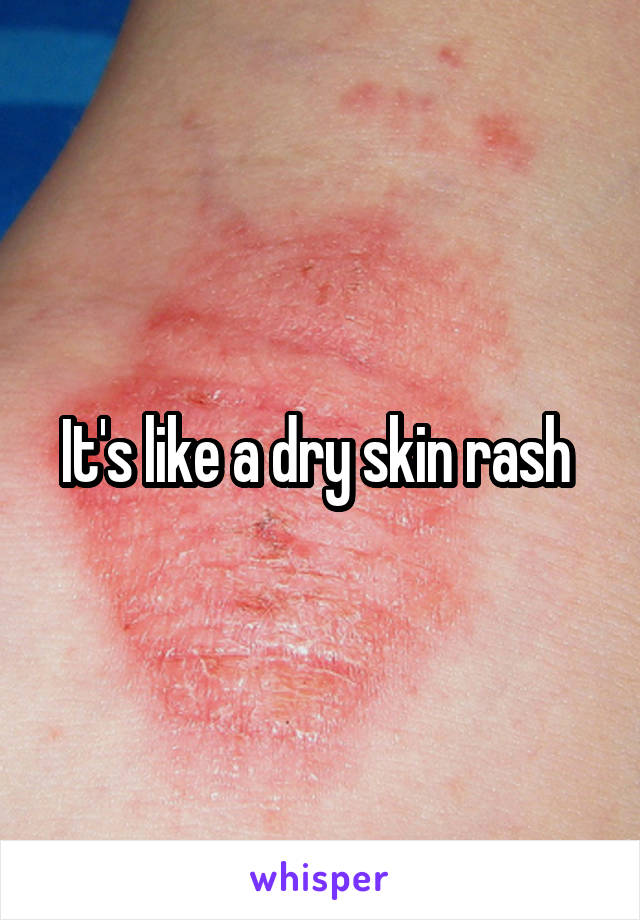 It's like a dry skin rash 