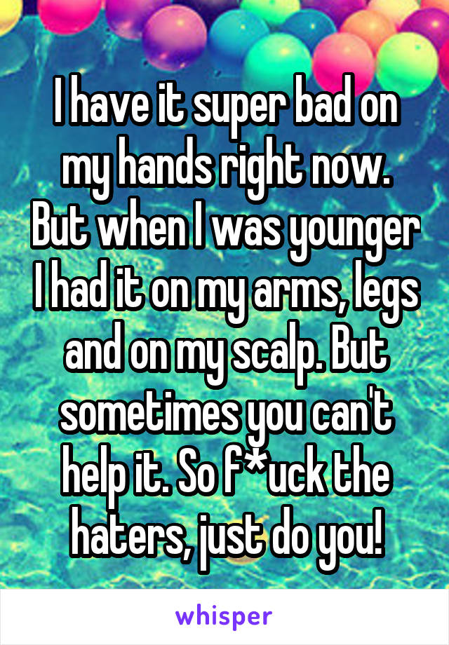 I have it super bad on my hands right now. But when I was younger I had it on my arms, legs and on my scalp. But sometimes you can't help it. So f*uck the haters, just do you!