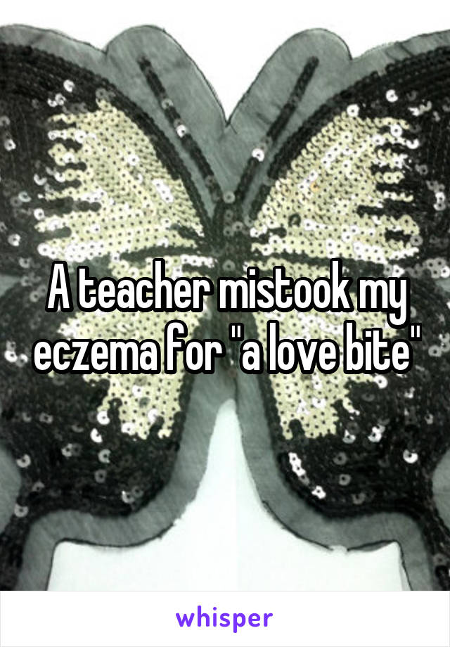 A teacher mistook my eczema for "a love bite"