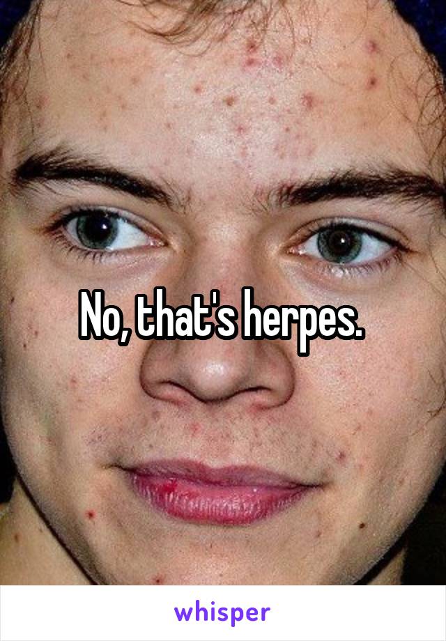 No, that's herpes. 