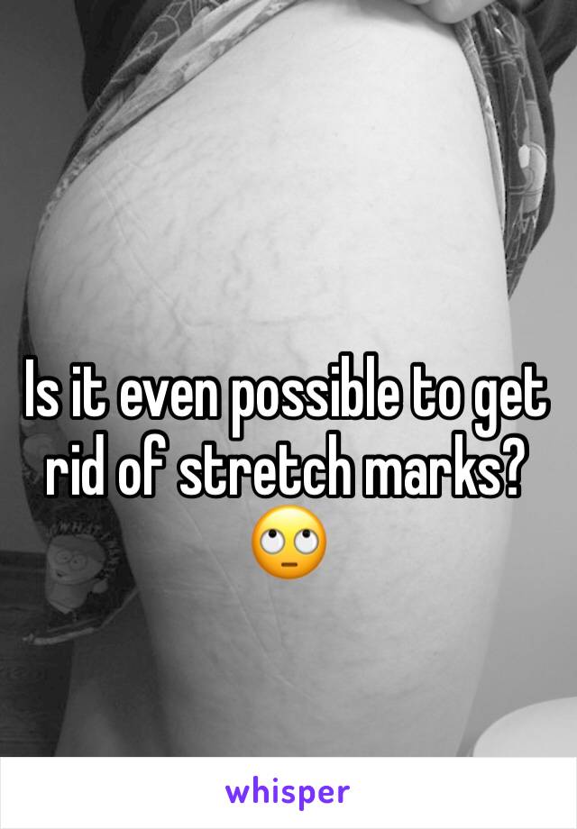 Is it even possible to get rid of stretch marks? 🙄