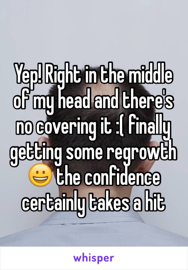 Yep! Right in the middle of my head and there's no covering it :( finally getting some regrowth 😀 the confidence certainly takes a hit