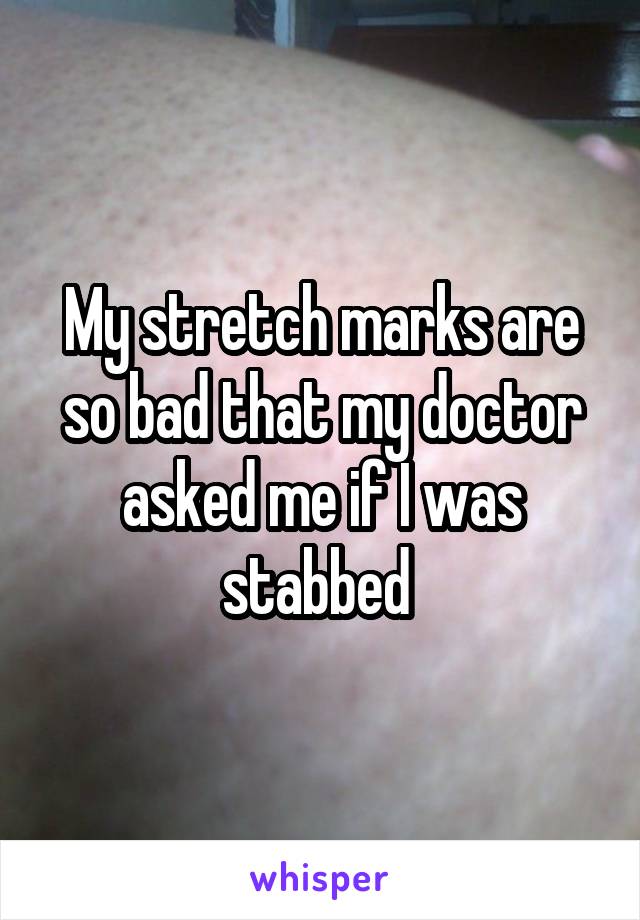 My stretch marks are so bad that my doctor asked me if I was stabbed 