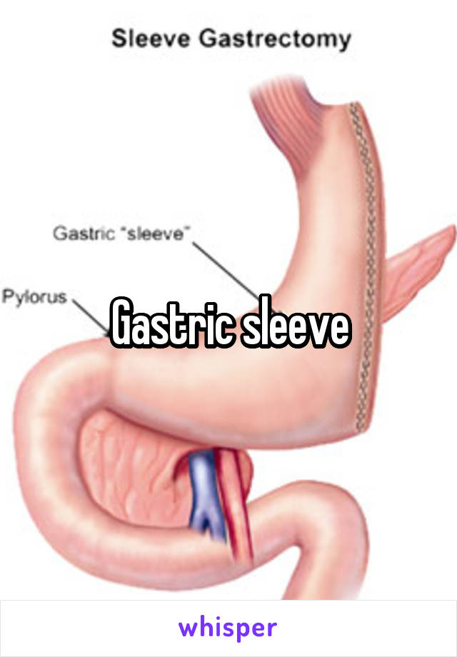 Gastric sleeve