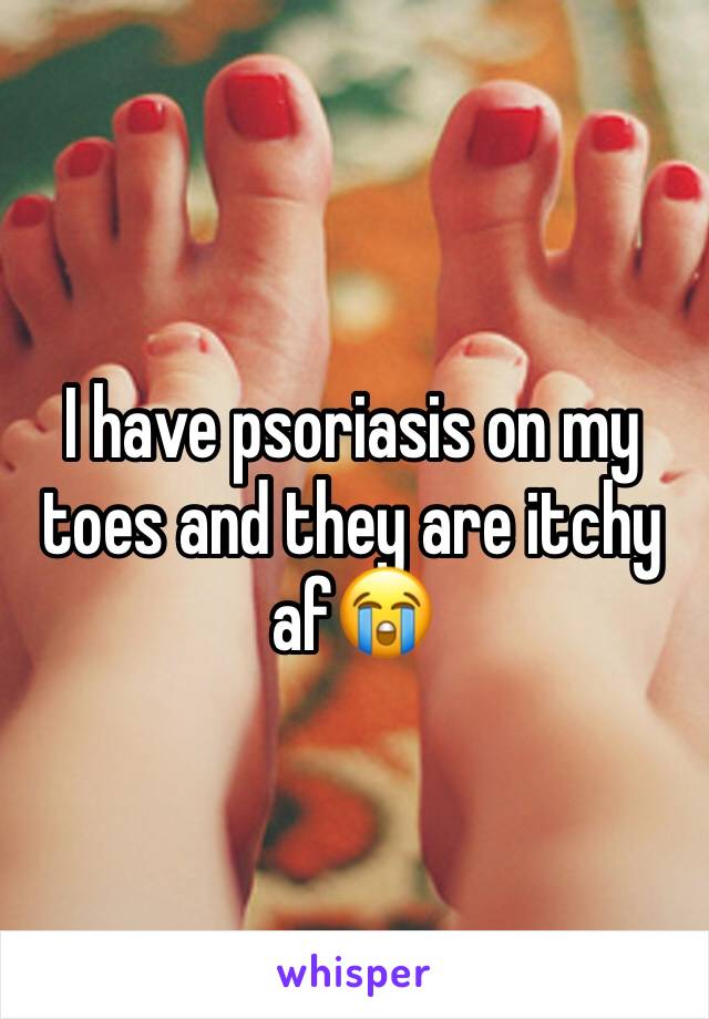 I have psoriasis on my toes and they are itchy af😭