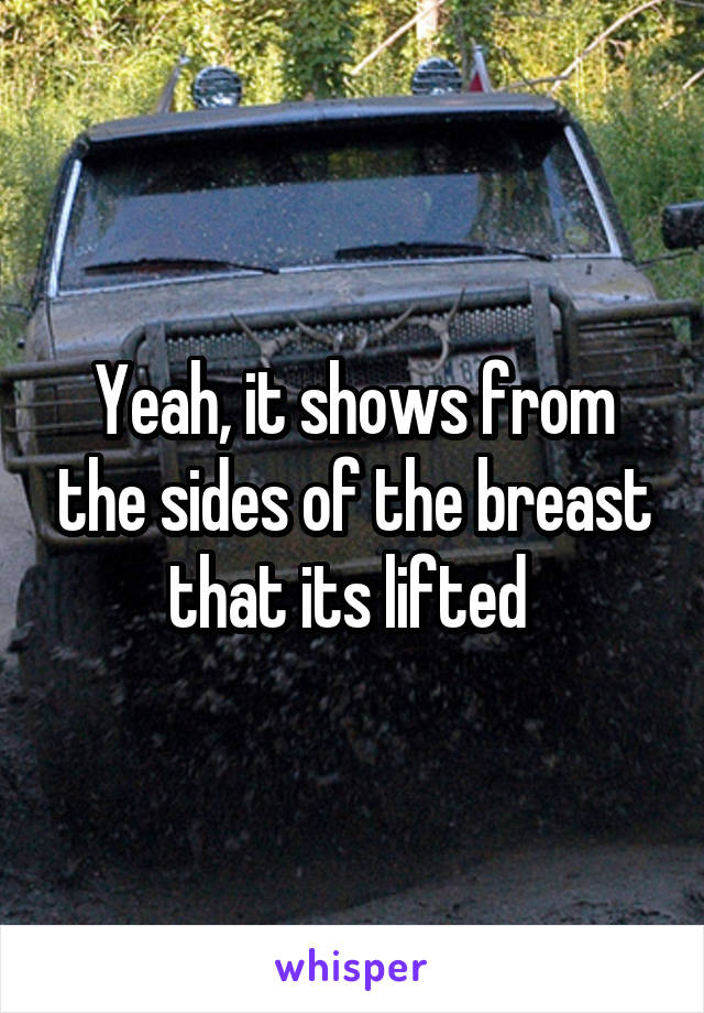 Yeah, it shows from the sides of the breast that its lifted 