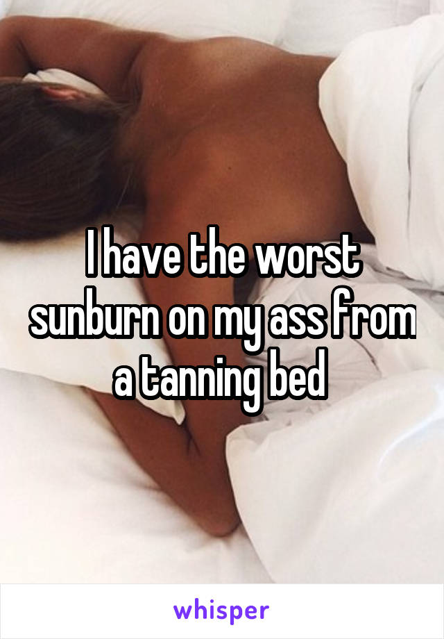 I have the worst sunburn on my ass from a tanning bed 