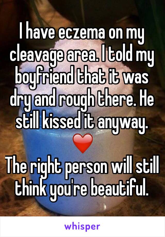 I have eczema on my cleavage area. I told my boyfriend that it was dry and rough there. He still kissed it anyway. ❤️
The right person will still think you're beautiful. 