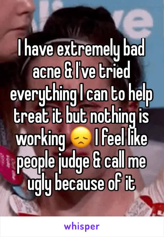 I have extremely bad acne & I've tried everything I can to help treat it but nothing is working 😞 I feel like people judge & call me ugly because of it 