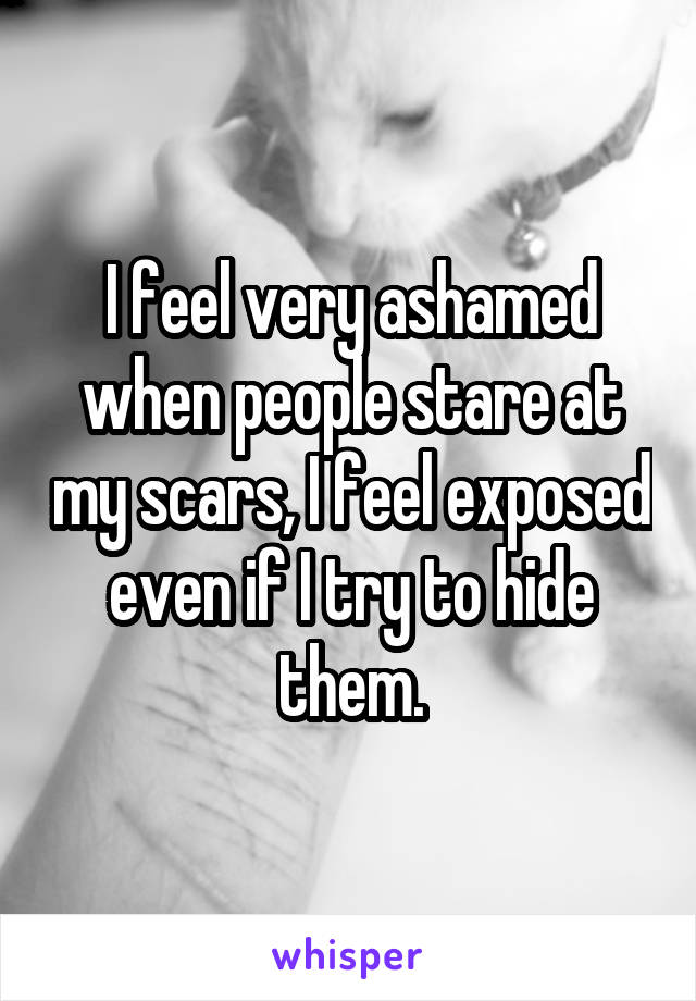 I feel very ashamed when people stare at my scars, I feel exposed even if I try to hide them.