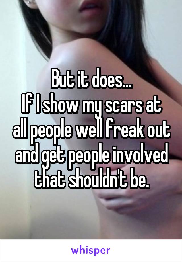 But it does...
If I show my scars at all people well freak out and get people involved that shouldn't be.